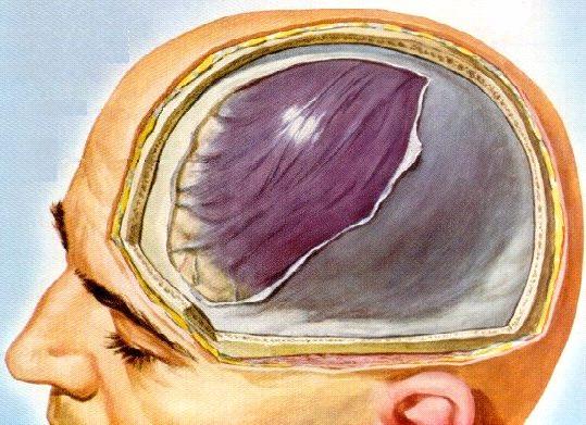 negli anziani, dove a causa della normale atrofia cerebrale si verifica l aumento dello spazio sotto-durale, cioè di quello spazio