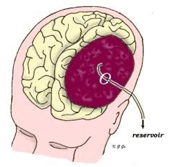 TRATTAMENTO Alcune volte può essere di tipo conservativo, con riposo e TAC cerebrali ripetute nel tempo per controllarne l evoluzione.