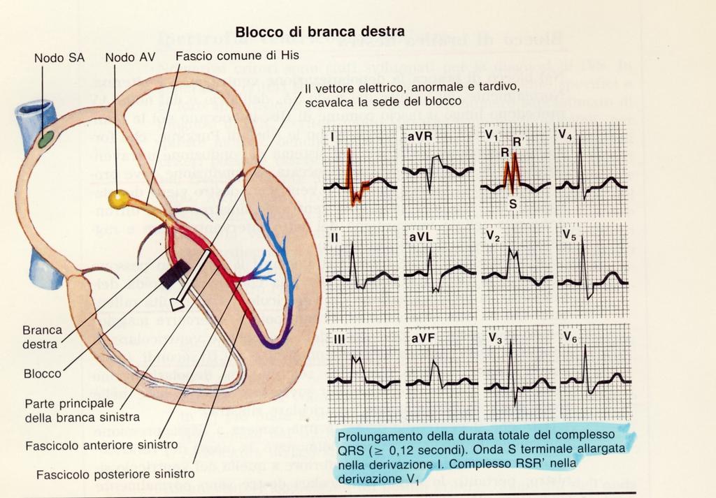 intervallo PR corto e di un complesso QRS normale per morfologia e durata.la diagnosi si effettua con maggior precisione effettuando lo studio elettrofisiologico endocavitario. 12.