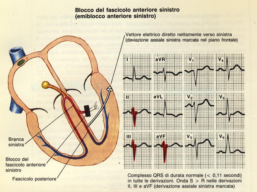 La branca sinistra si divide in due ramificazioni: i fascicoli anteriore e posteriore. Il blocco del fascicolo anteriore è relativamente comune.