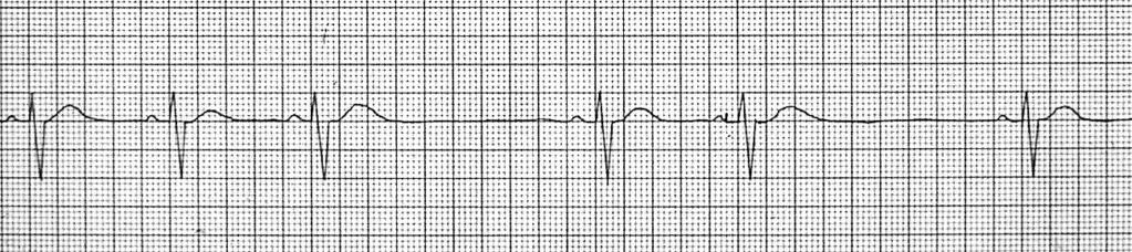 Aspetti clinici: la portata cardiaca può ridursi determinando vertigini o sincopi. 12