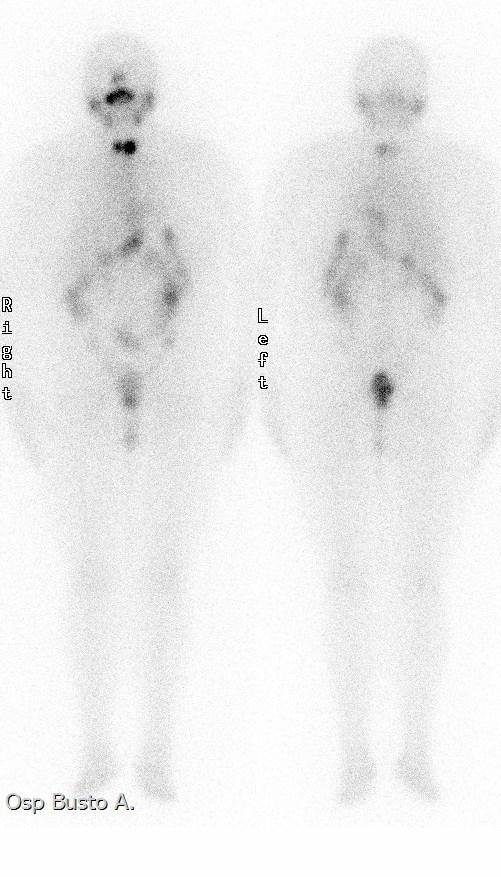 TERAPIA 131 I DOPO R- TSH, PER LA SIDERAZIONE DEL