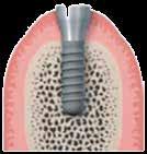 1 - Procedura chirurgica 1.1 Preparazione sito implantare 1.