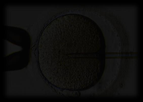 La coppia ha effettuato 2 ICSI 1^ ICSI analogo depot del GnRh + Gonadotropina (225 UI die) induzione con LH in 12 g di stimolo E2:1564 pgr/ml; Prog.