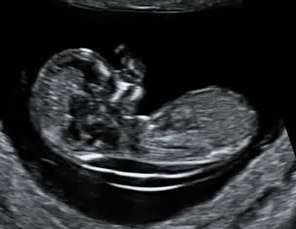 Nuchal translucency (mm) 1990s: Nuchal translucency Screening for