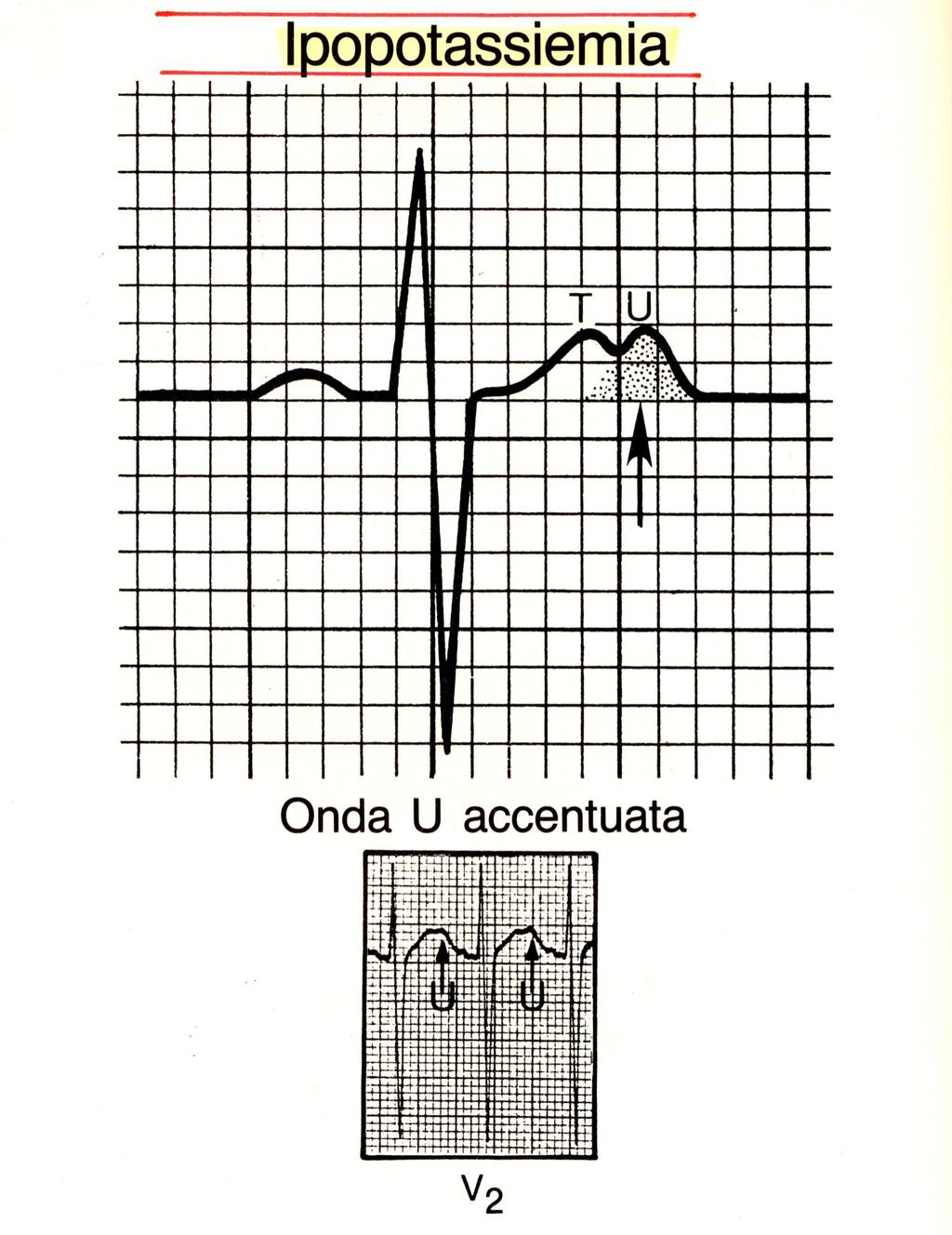 14.12 Ipopotassiemia L'ipopotassiemia può produrre evidenti alterazioni dell'ecg, come un sottoslivellamento del tratto ST, un appiattimento della T e la comparsa o