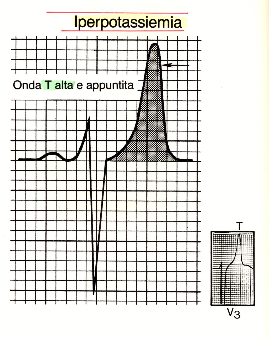 Controlli elettrocardiografici ravvicinati di un paziente durante la correzione dell'ipopotassiemia, mostreranno un graduale aumento delle T con la scomparsa dell U.