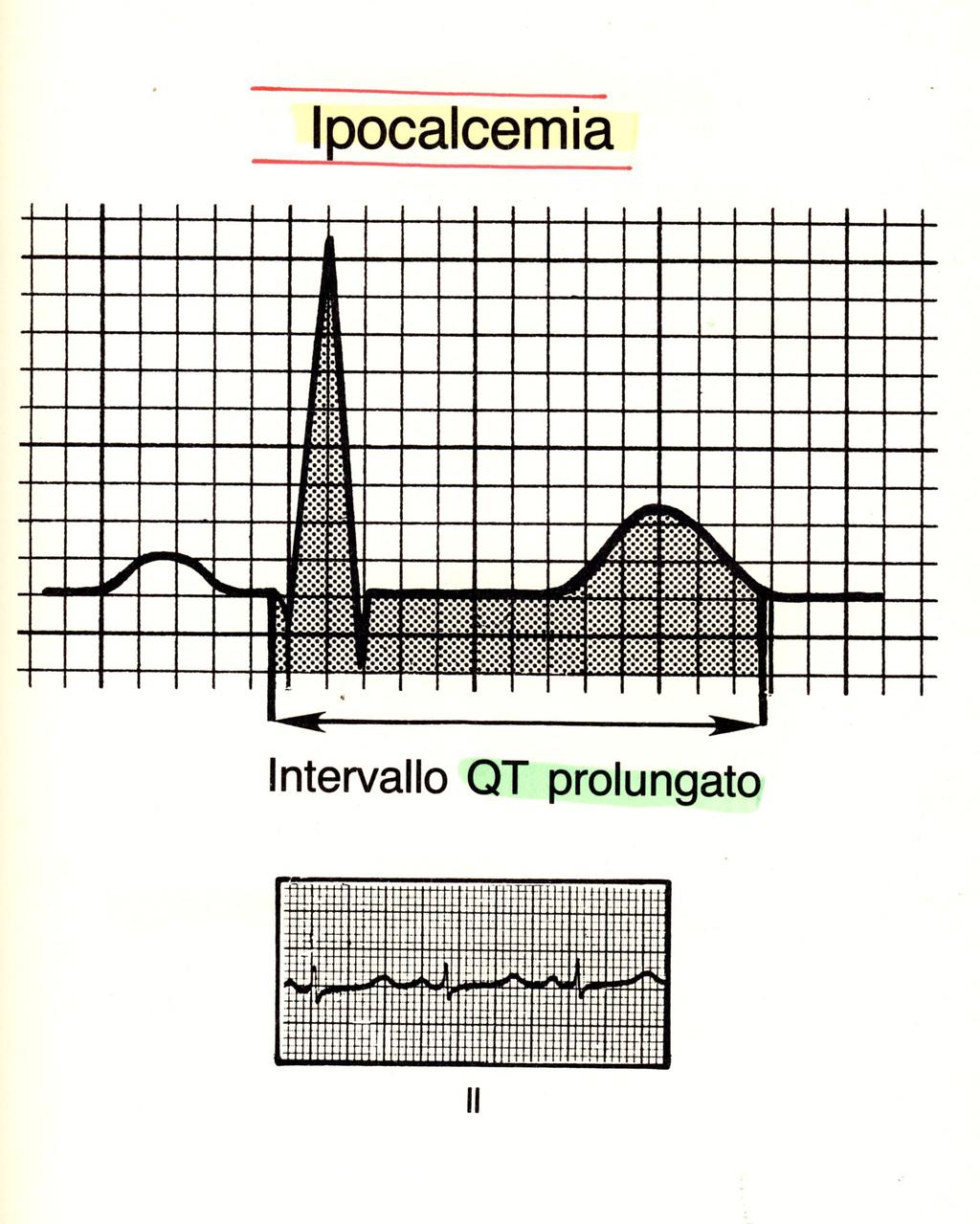 14.14 Ipocalcemia In un paziente con bassi livelli sierici di calcio, l'intervallo QT può essere molto prolungato 14.