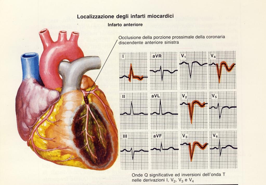 14.2 Localizzazione degli infarti miocardici Gli infarti vengono localizzati da un punto di vista elettrocardiografico a seconda delle derivazioni coinvolte. 14.2.1