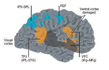 NUOVO MODELLO ANATOMO-FUNZIONALE Danno strutturale al sistema attenzionale ventrale (VAN, bottom-up) + danno funzionale al sistema attenzionale dorsale (DAN, top-down) strutturalmente intatto