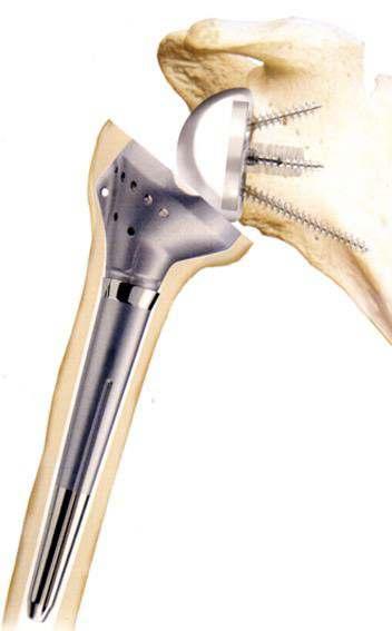 a prosthesis