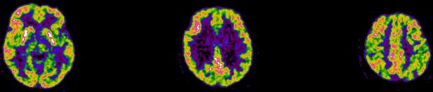 La FDG-PET è più sensibile della CSF (p)(t)tau come biomarker di neurodegenerazione? Uomo 65 aa 2009: MMSE 30 2009: RAVLT: 31 R.