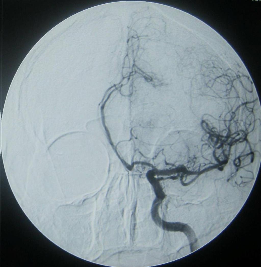 Lo studio angiografico evidenzia la dislocazione verso destra delle arterie cerebrali anteriori di circa 3 cm