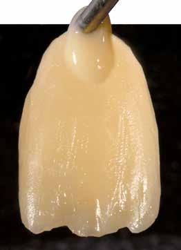 Stratificazione individuale 1 max. mm Applicare crea.lign in pasta A sul corpo del dente. Applicare crea.lign A,5 sul colletto del dente.