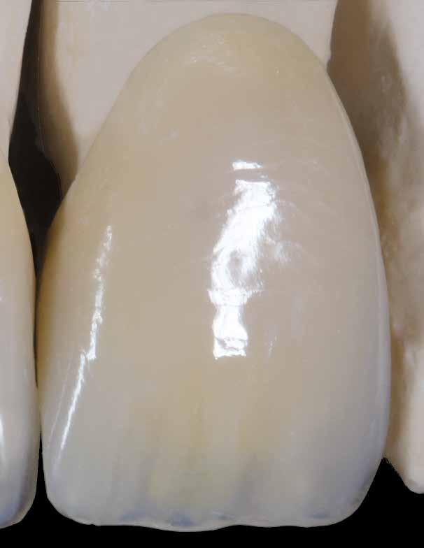 paint ebony, vengono creati dei contrasti scuri nella zona del colletto del dente. Con visio.paint ebony vengono realizzate le fessure sottili.