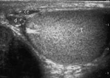 EcocolorDoppler della borsa scrotale Mediastino testicolare scansione assiale: