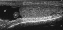 EcocolorDoppler della borsa scrotale Testicolo (appendice testicolare) L appendice del testicolo (at), o idatide di Morgagni, è riconoscibile al polo