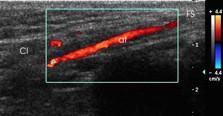 Si evidenzia in rosso (flusso in avvicinamento rispetto alla sonda) un tratto dell arteria al centro del funicolo spermatico (FS) Arteria testicolare in sede scrotale. CI: canale inguinale.