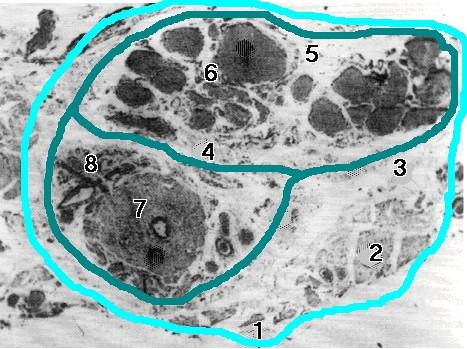 EcocolorDoppler della borsa scrotale Funicolo spermatico Sono sempre ben dimostrabili le vene del plesso pampiniforme, di calibro normalmente inferiore ai 2 mm e il deferente.