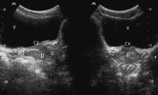 Ecografia prostato vescicolare Prostata: organo muscolo-ghiandolare, conformato "a castagna.