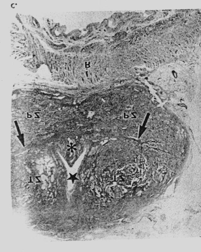 Ecografia prostato vescicolare Prostata: transition zone: ca 5% del tessuto ghiandolare si localizza ai due lati dell'uretra prossimale, subito al di fuori dello "sfintere preprostatico.