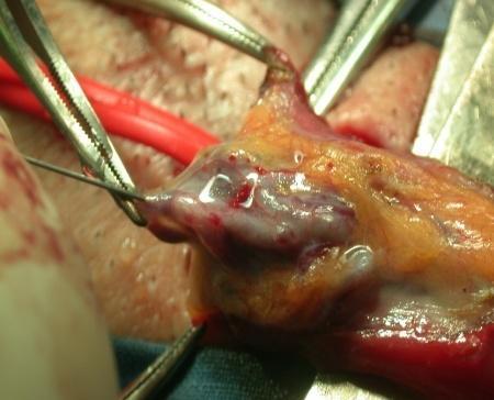Sclerotizzazione subinguinale del varicocele sec. Colpi et al. La finalità dell intervento chirurgico consiste nell interruzione del reflusso esistente nella vena spermatica interna.