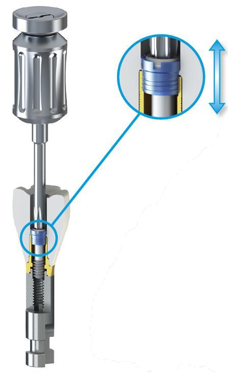 ANELLO DI TENUTA L ANELLO DI TENUTA è progettato esclusivamente per essere utilizzato con il sistema di convertitori IPD, garantendo il fissaggio meccanico provvisorio della protesi all'attacco senza