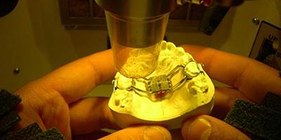 Perchè il laser in Ortodonzia Da quando esiste l ortodonzia e qui ci perdiamo nella notte dei tempi, c è sempre stata la necessità di unire due o più parti metalliche per permettere la costruzione di