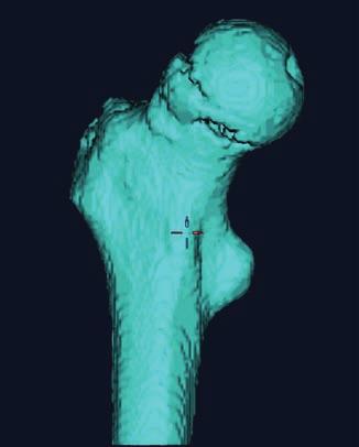 medicad Hip 3D Segmentazione dell osso e osteotomie La segmentazione manuale costituisce un