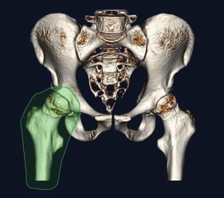 Con questa segmentazione è possibile visualizzare liberamente determinate aree dell'osso come