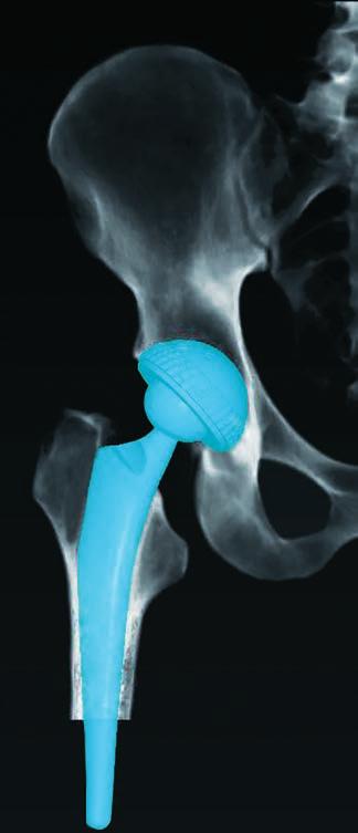 Il configuratore impianti permette di selezionare tra diverse protesi dell'anca.