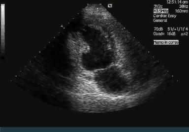 Ecocardiogramma Ventricolo sinistro di normali dimensioni con spessori parietali aumentati (ipertrofia ventricolare sinistra) Acinesia