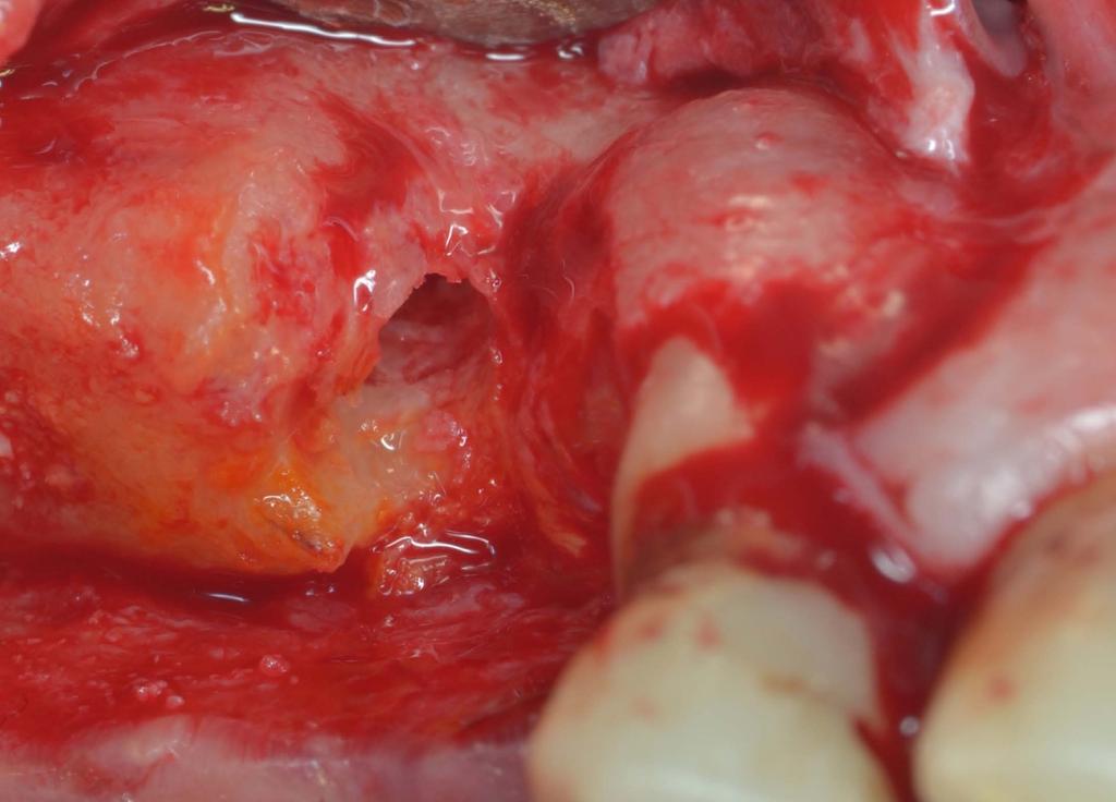 della rimozione delle suture Guarigione dei