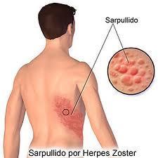 Diagnosi differenziale Con il termine Fuoco di S. Antonio viene oggi comunemente definita una patologia che in ambito medico è conosciuta come Herpes Zoster.