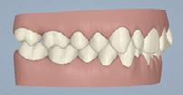 È più predicibile trattare il morso profondo con Invisalign se... 1. Sia i denti superiori che i denti inferiori sono diritti o inclinati lingualmente. 2. L occlusione posteriore è di Classe I.