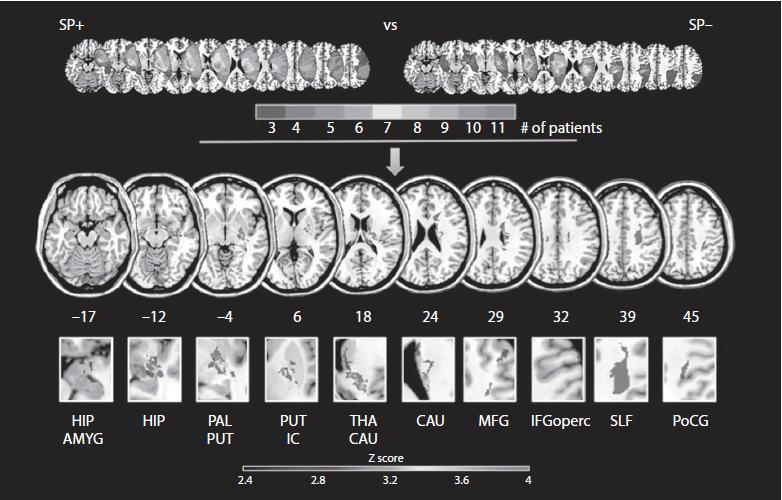 Somatoparafrenia Originariamente descritto da Gerstmann (1942), è un sintomo produttivo, caratterizzato da un delirio selettivo riguardante l arto colpito da paralisi, conseguente a una lesione