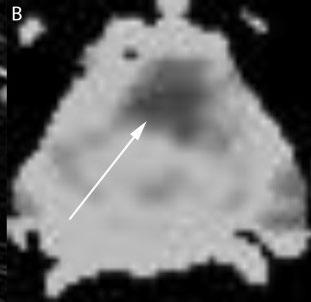 neoplasia vista come regione scura (ipointensa) Diffusion-weighted Imaging