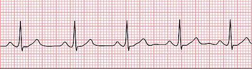 quando il ritmo caridaco non è stabilito dal nodo del seno, e/o della conduzione intracardiaca dell impulso elettrico (Brunner - Suddarth, 2010).