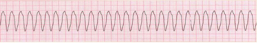 4.5 Tachicardia ventricolare La tachicardia ventricolare (TV) è definita come una sequenza di tre o più extrasistoli ventricolari, con una frequenza maggiore di 100 battiti al minuto (Brunner -