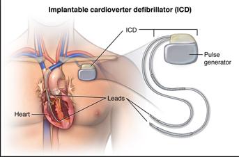 di corrente ad energia maggiore di quello erogato per la cardioversione. Questa terza tecnica di ripristino del ritmo sinusale viene chiamata defibrillazione.