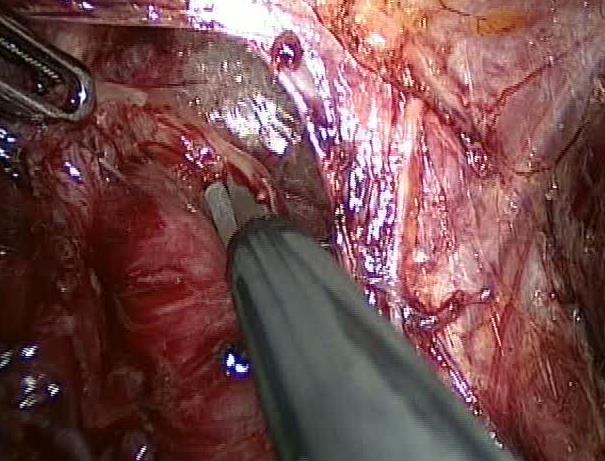 sgonfiato (40-60 ml di aria) Viene eseguita una miotomia