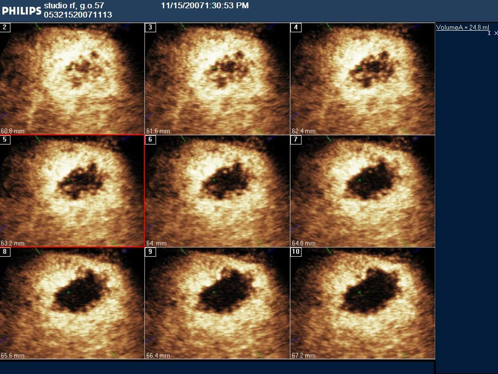 Necrosi avascolare Tessuto vitale vascolarizzazione