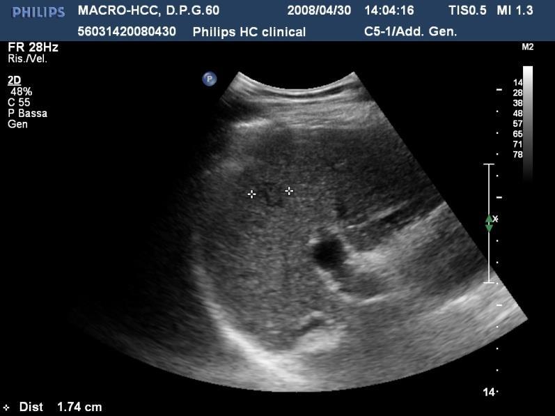 NODULI IN CIRROSI