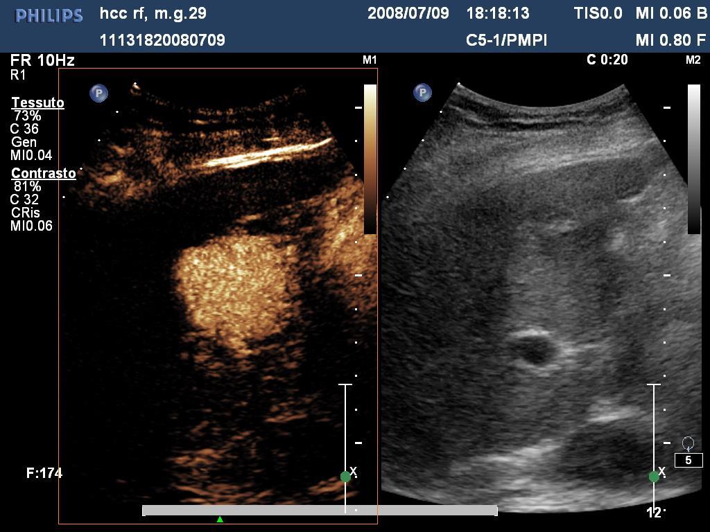 CEUS HCC PATTERN TIPICO