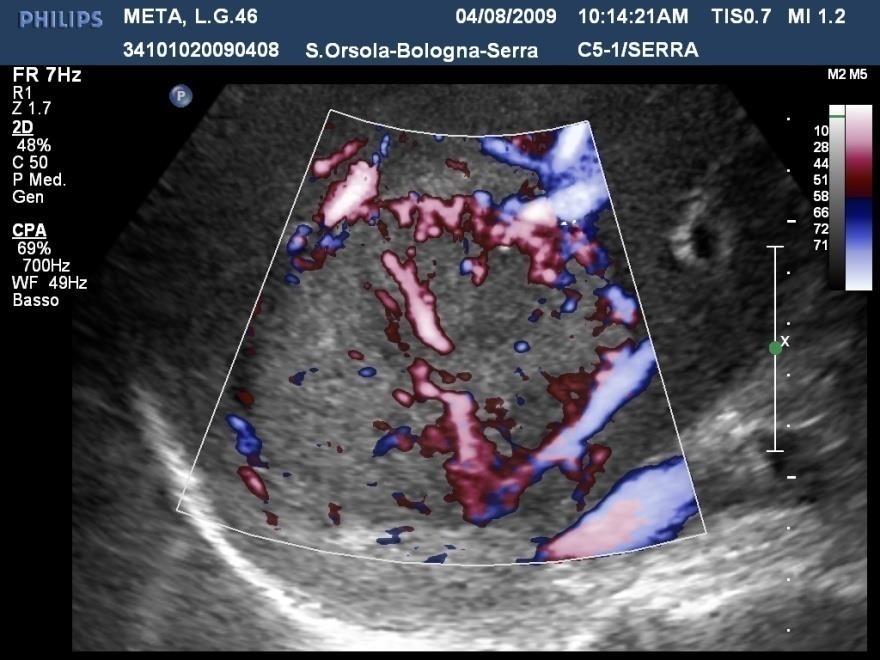 CEUS: METASTASI EPATICHE CEUS gioca un ruolo chiave nella