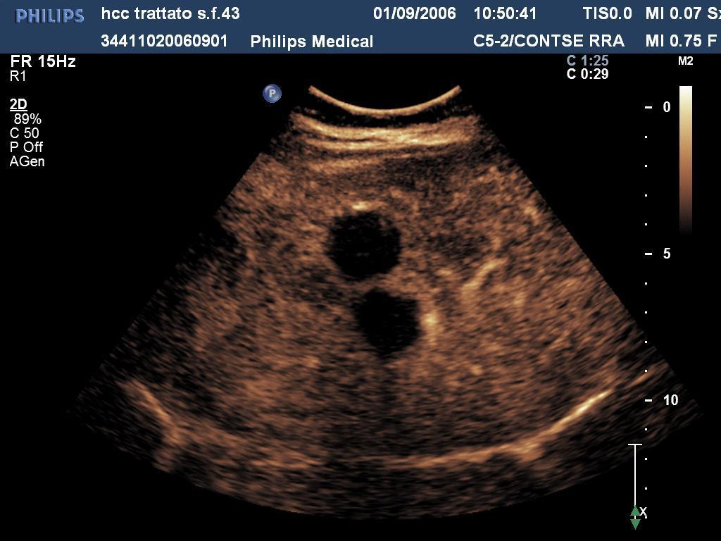 Goldberg, Cancer 2000 CE-CT and CE-MNR are the gold standards to evaluate the efficacy of radiofrequency treatments and to detect recurrences There is a good correlation between the necrotic