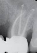 I dentisti e gli endodonzisti di tutto il mondo hanno manifestato il loro apprezzamento per la semplicità d uso di che permette di assicurare ai pazienti trattamenti