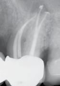 GOLD introduce nella procedura endodontica una tecnica per la sagomatura canalare eseguita con un solo strumento avanzato dal punto di vista metallurgico.