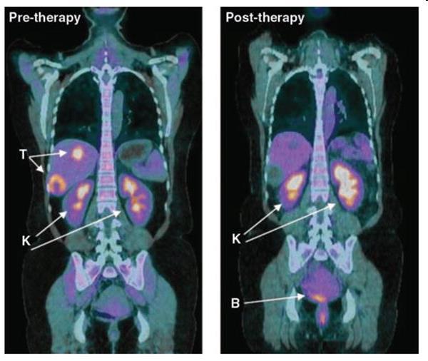 Diagnosi dei tumori con la PET Il fenotipo metabolico della cellula neoplastica è la base per l imaging dei tumori divenuta un importante mezzo per la diagnosi ed il trattamento del cancro Viene