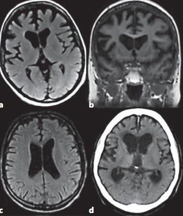 Diverso pattern di atrofia cerebrale atrofia corticale frontotemporale